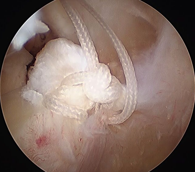 Mensical Root Sutures